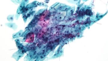 Infecciones fúngicas