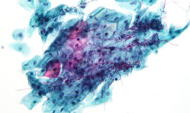 Infecciones fúngicas