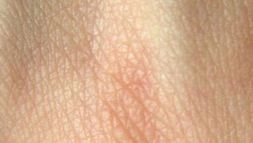 ¿Cuáles son las enfermedades de la piel?